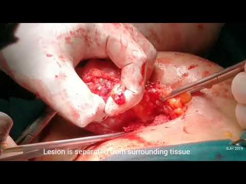 Inframammary Approach for Giant Fibroadenoma of inner upper quadrant  By Prof. Dr. Ajit Sinha Video
