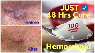 How To Cure Piles At Home Fast in Just 48 Hours!
