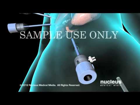 胆嚢手術 – 手術の概要、回復、リスク、ケア