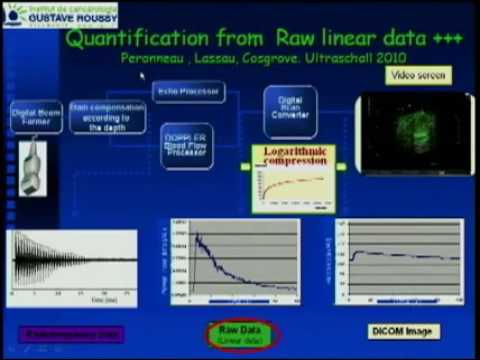 Interest of Dynamic Contrast Enhanced Ultrasonography DCE US for the Early Evaluation of Anti Angiog