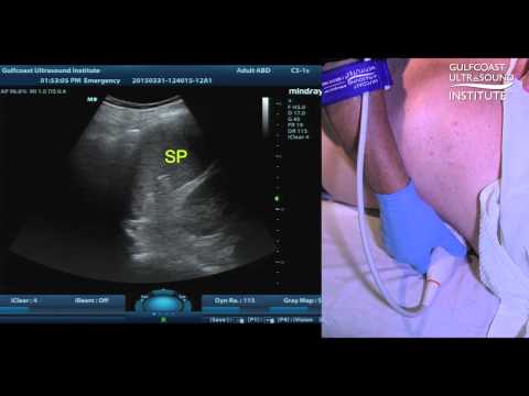 Hot Tips - Scanning the Spleen in the Supine Position