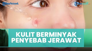 Penjelasan Wajah Berminyak Menyebabkan Jerawat