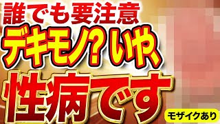 【尖圭コンジローマ】ニキビと勘違い？性病除去+包茎手術の全貌を公開！
