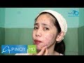 Pinoy MD: Pimple myths: Mga epektibo at 'di epektibong paraan para mawala ang pimples
