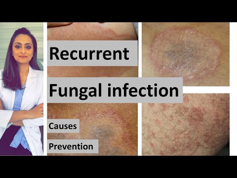 Recurrent fungal infection | causes| How to prevent