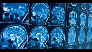 Tägliche Gehirnattacken – Dr. Manfred Doepp