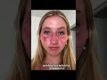 wear sunscreen it’s not worth it #beach #sunburn #sunpoisoning #summer #sunscreen
