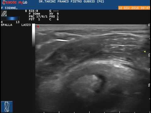 Mal di schiena e potenza negli uomini Trattamento di osteocondrosi toracica in gravidanza