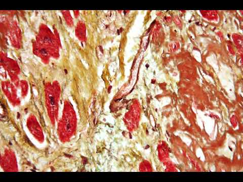 Cardiovascular disease | Wikipedia audio article