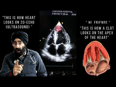 Blood Clot In Heart 