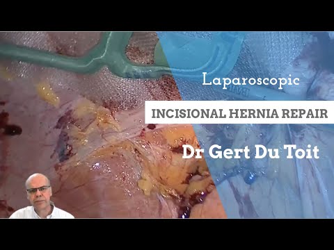 Laparoscopic Incisional Hernia Repair or an intra-peritoneal onlay mesh (IPOM) repair