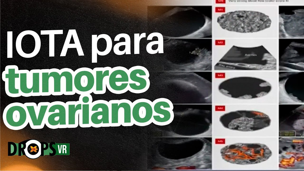 CRITÉRIOS IOTA PARA LESÕES OVARIANAS NO ULTRASSOM I VOCÊ RADIOLOGISTA