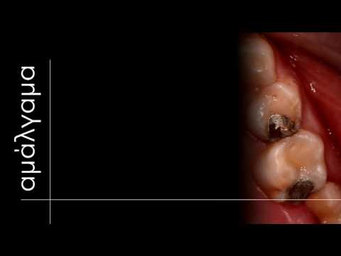 Αποκαταστάσεις Β' Ομάδας νεογιλών δοντιών. Τι υλικό να επιλέξω; (Dental TTT - Webinar Νο 22).