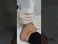 ND YAG for removal foot tattoo