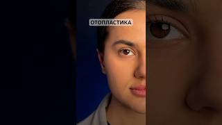 Otoplasty 64