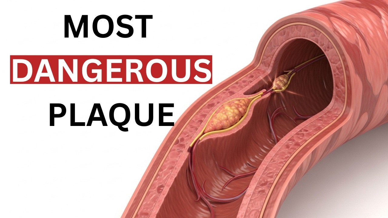 The Most Dangerous Plaque Isn’t The Biggest (Heart Attack Explained)