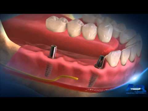 İmplant Çözümortağımız A.B Dental Devices 1