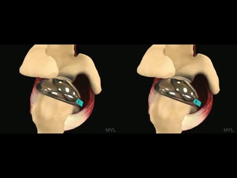 Force couple after shoulder replacement