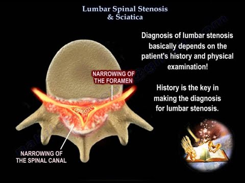 Sténose Rachidienne Lombaire et Sciatique - Dr Nabil Ebraheim