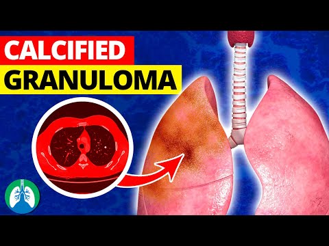 What is a Calcified Granuloma in the Lungs?