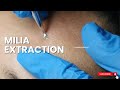 MILIA EXTRACTION ON THE FOREHEAD