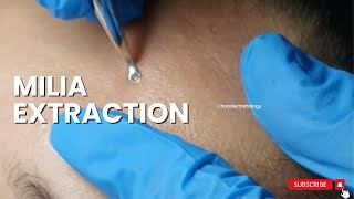 MILIA EXTRACTION ON THE FOREHEAD