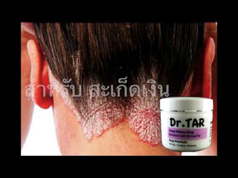 การรักษา RB ของโรคสะเก็ดเงิน เซลล์โรคสะเก็ดเงินภายใต้กล้องจุลทรรศน์