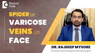 Spider Veins/Varicose Veins On Face-Tips to Get Rid of it!#beauty -Dr.Rajdeep Mysore|Doctors