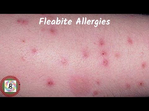 Home Remedies to Heal Flea Bites on Humans, and Time Duration to Prevent Flea Bites