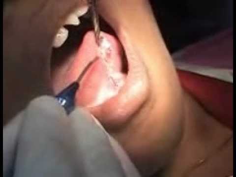 Laser Dentistry by Dr. Rangeeth.B.N