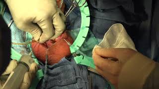 Download lagu Penile Implant Revision for Herniated Reservoir and Flipped Pump mp3