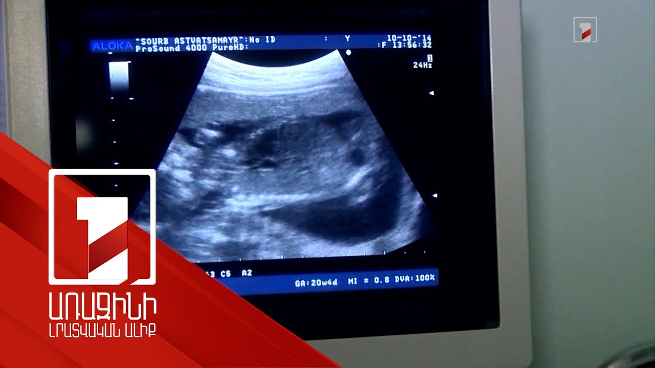 Անպտղության հաղթահարման ծրագրից կարող են օգտվել 20-42 տարեկան ամուսնացած և չամուսնացած կանայք