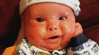 New York Mom Bathes 1-Year-Old Son in Bleach to Treat Rare Skin Condition