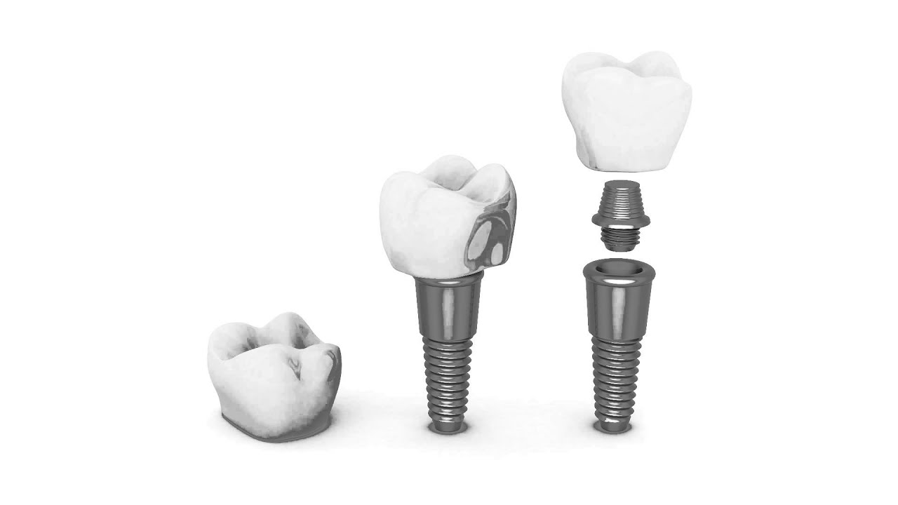 Implants at The Dental Studio