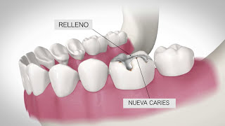 ¿Qué es una Corona Dental Precio corona dental de Zirconio