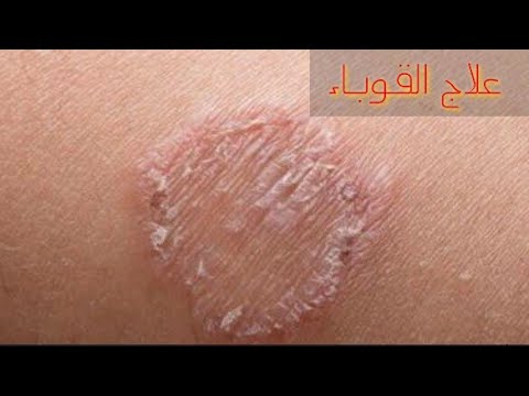 القوباء ( الوصفة التقليدية المضمونة )