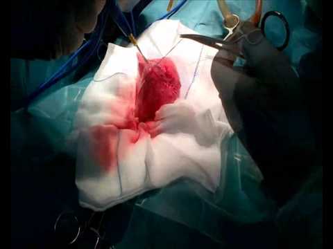 Rulid per la prostata Ridurre in pani su prostata