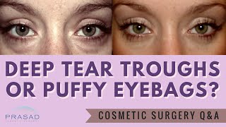 Puffy Eye Bags are Often Mistaken for Deep Tear Troughs - Treatment Differs on Severity