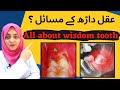 Wisdom Tooth FAQs Aqal Darh Ka Nikalna Urdu