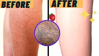 HOW TO GET RID OF STRAWBERRY LEGS IN ONE DAY! Get Rid Of Keratosis Pilaris And Dark Spots On Legs