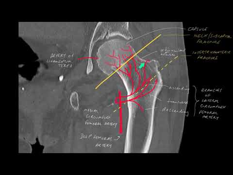 Know your hip fractures and the importance of arterial anatomy of the proximal femur