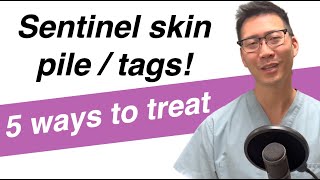 5 ways to deal with Sentinel Skin Tag/Piles!