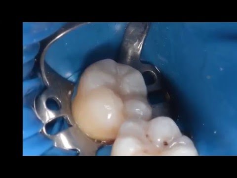 Composite direct restoration on molar (Microbrush stamp technique)