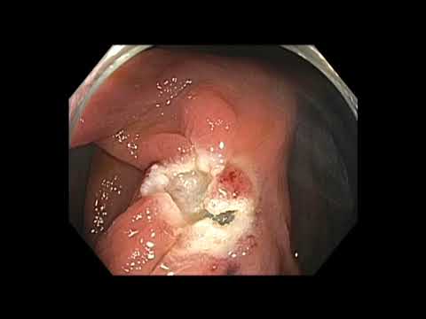 Colonoscopy: Ascending Colon Polyp Recurrence After Three Prior Resections