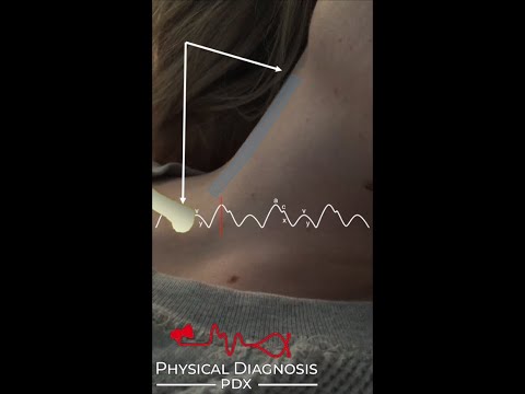Normal Jugular Venous Pulse (Narrated)