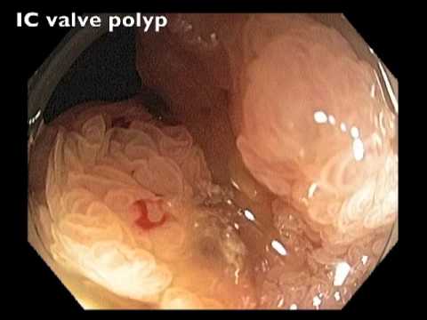 Polype de la Valvule Iléo-cæcale - Échec de Résection