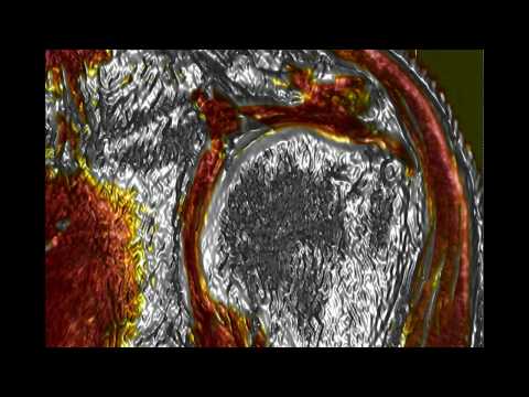 Rotator cuff tear - bursal side dominant full thickness tear Video