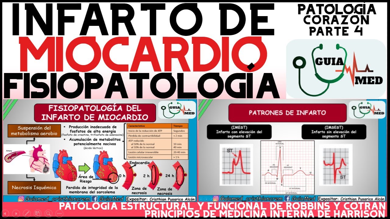 INFARTO AGUDO AL MIOCARDIO FISIOPATOLOGÍA | GuiaMed