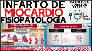 INFARTO AGUDO AL MIOCARDIO FISIOPATOLOGÍA | GuiaMed