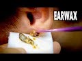 THE BEST EARWAX REMOVAL EVER!  (and most gross)  | Dr. Paul